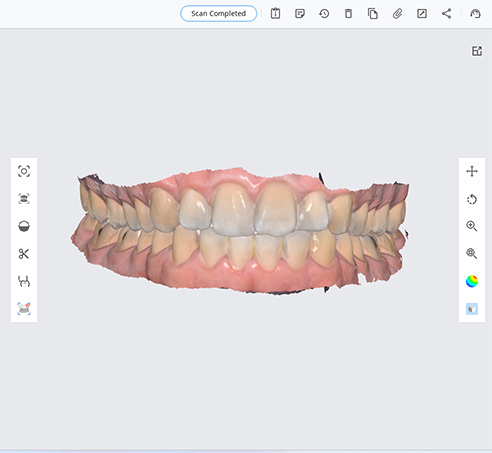 Screenshot eines Programmes zur Erstellung von intraoralen 3D Scans mit dargestelltem 3D Scan eines Ober- und Unterkiefers